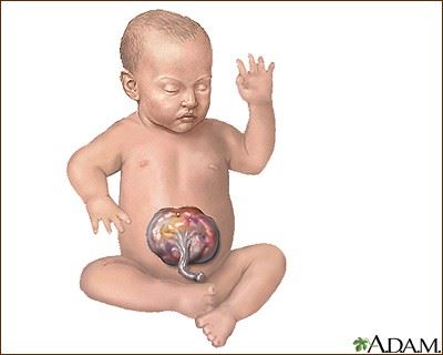 Abdominal Birth Defects Omphalocele
